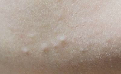 起粉刺怎么解决不用任何工具,起闭口粉刺怎么消除