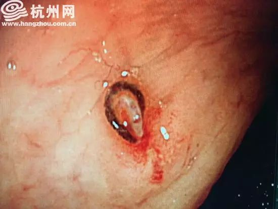 两年前做过肠镜两年后又出现便血,女子做肠镜便血