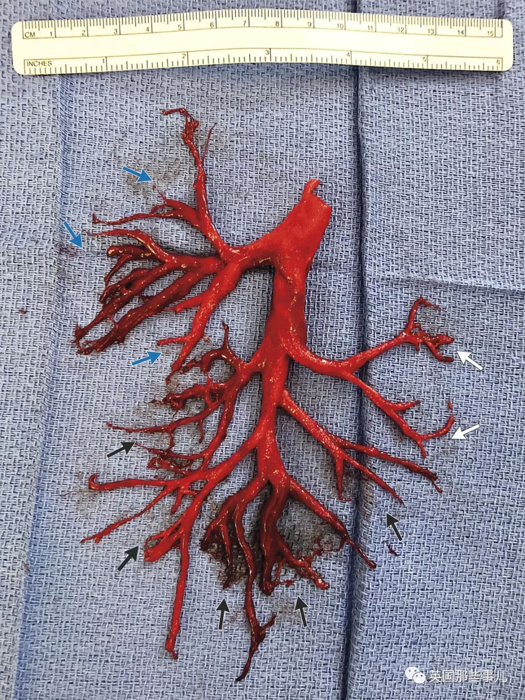 咳血咳出肺部组织,咳血然后咳几下就舒服了怎么回事