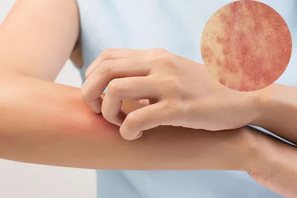 脚气湿疹止痒最快的软膏,湿疹止痒膏可以治脚气吗