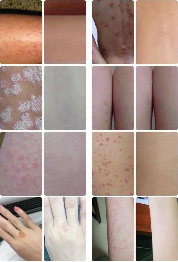 脚气湿疹止痒最快的软膏,湿疹止痒膏可以治脚气吗