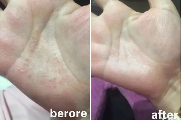 脚气湿疹止痒最快的软膏,湿疹止痒膏可以治脚气吗