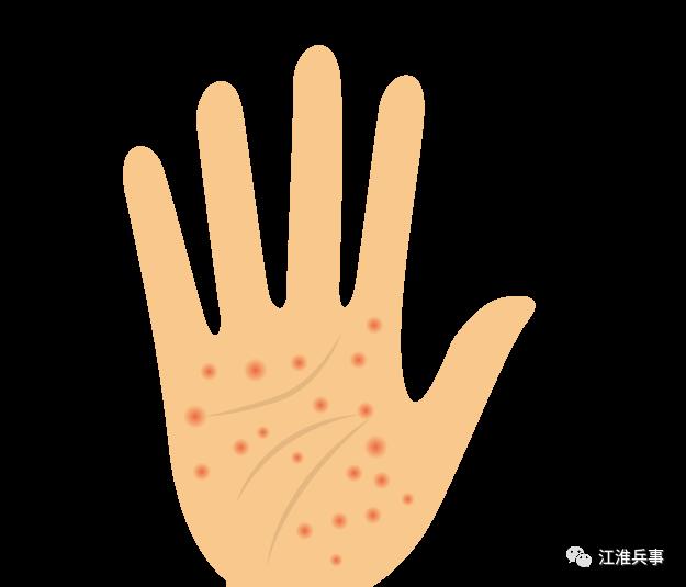 冬天湿疹痒醒,小孩冬天湿疹瘙痒怎么治