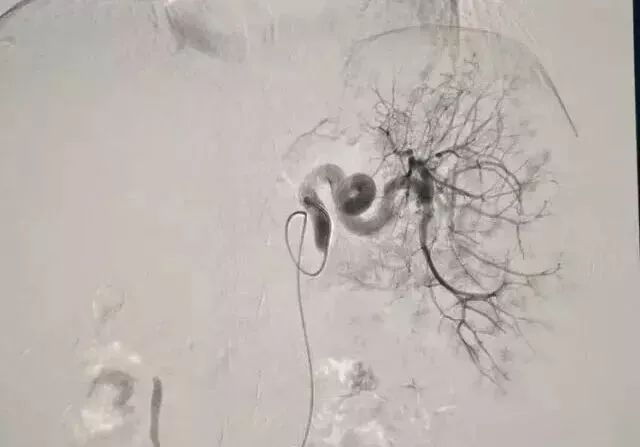 微创介入治疗肿瘤是什么科,介入治疗肿瘤副作用