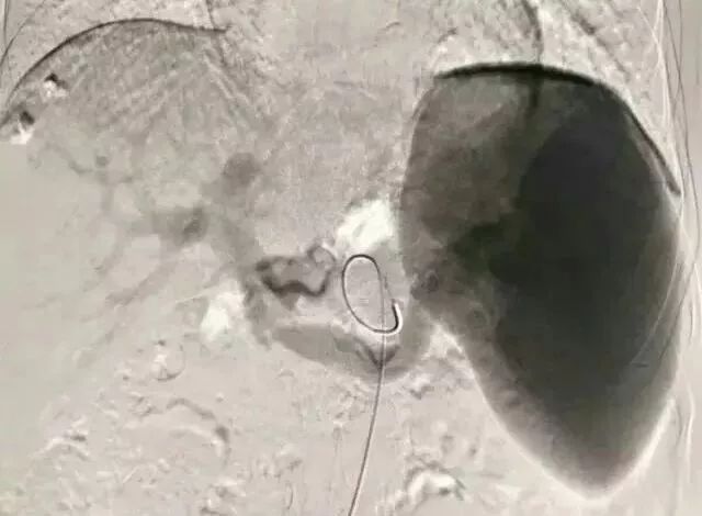 微创介入治疗肿瘤是什么科,介入治疗肿瘤副作用