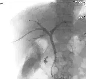 微创介入治疗肿瘤是什么科,介入治疗肿瘤副作用