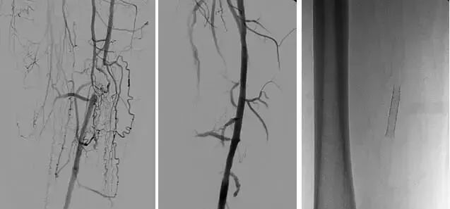 微创介入治疗肿瘤是什么科,介入治疗肿瘤副作用