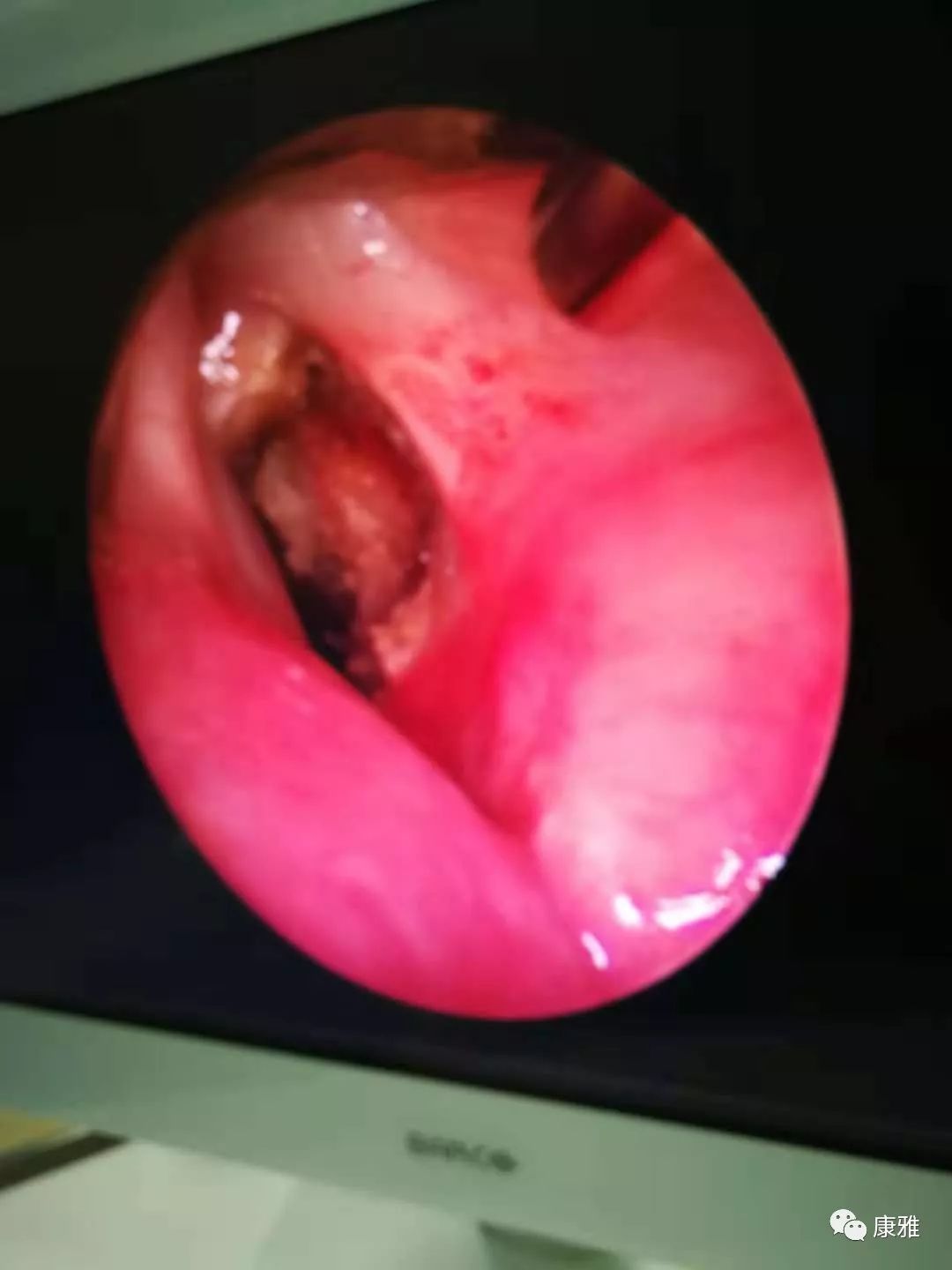 呼吸不畅嗓子难受声音嘶哑,声音嘶哑不治疗有什么后果