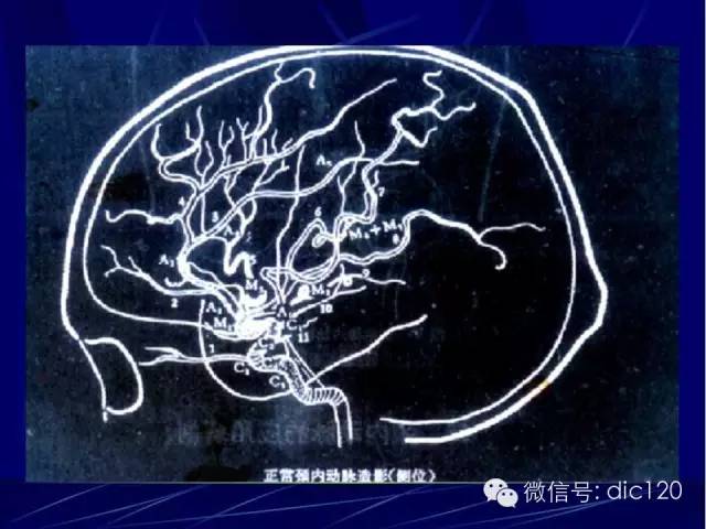 脑血管解剖技巧,脑血管解剖与介入