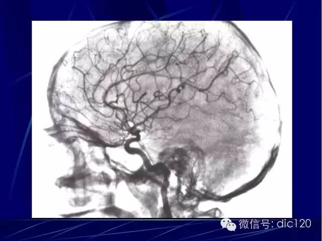脑血管解剖技巧,脑血管解剖与介入