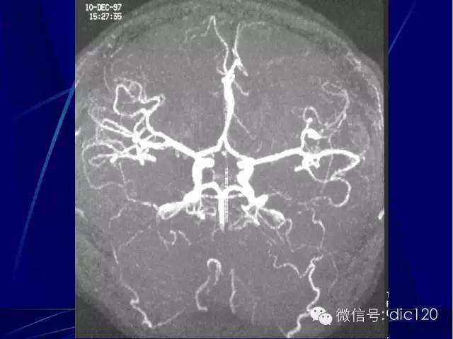 脑血管解剖技巧,脑血管解剖与介入