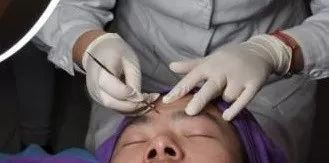 针清痘痘多少钱,针清脓包型痘痘