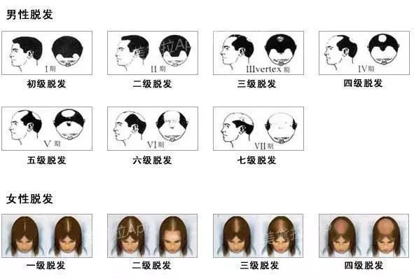 头等大事脱发青年自救指南,秃头女孩必看6大脱发误区