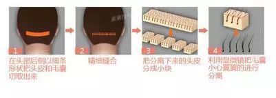 头等大事脱发青年自救指南,秃头女孩必看6大脱发误区