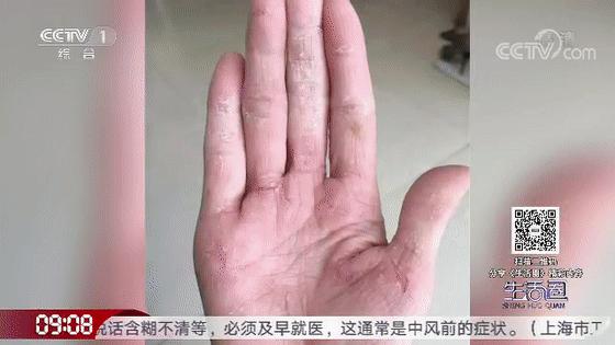 一到冬天手脚起皮干裂怎么治,冬天手脚干裂一招轻松缓解