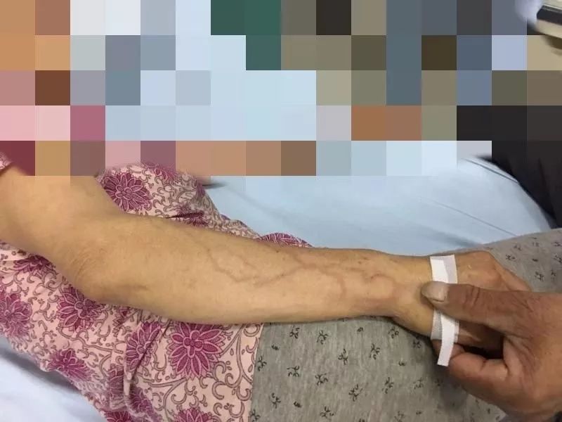 手臂输液后静脉炎怎么办,输液手臂出现索状红线