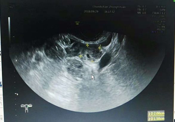 宫内孕合并宫外孕，医生护士协同作战降服病魔