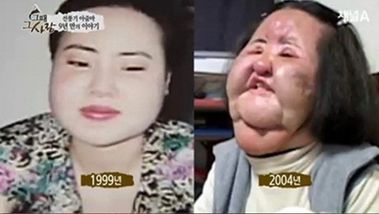 韩国整容毁容女逝去,整容电风扇大妈