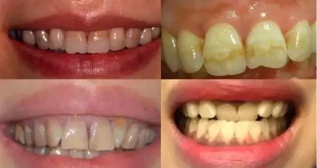 牙科牙齿美白全过程,牙齿黄又臭又烂牙怎么办