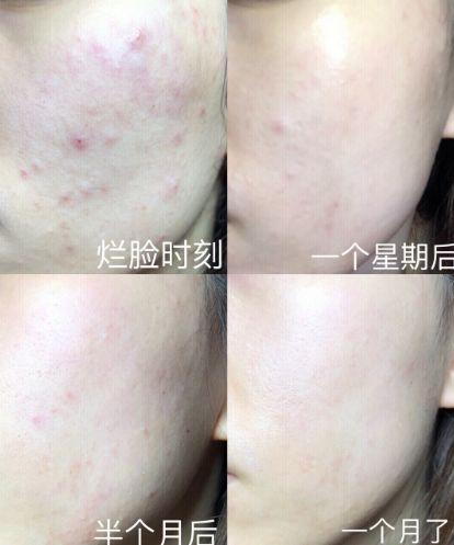 一熬夜吃辣就长毛囊炎,一熬夜一吃辣就长痘痘