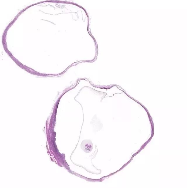 头皮上有个虫子,一女子头皮里有虫子