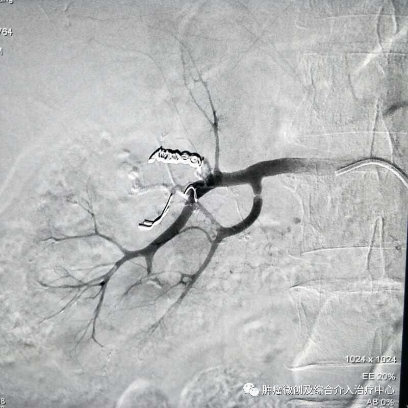 运城第一医院肿瘤介入科专家,运城市第一医院介入科专家