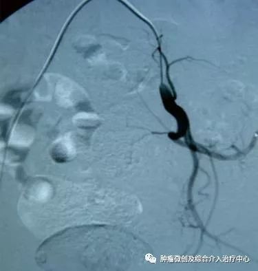 运城第一医院肿瘤介入科专家,运城市第一医院介入科专家