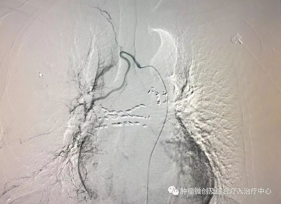运城第一医院肿瘤介入科专家,运城市第一医院介入科专家