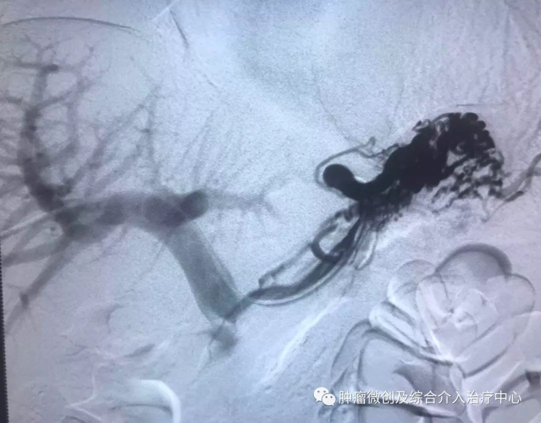 运城第一医院肿瘤介入科专家,运城市第一医院介入科专家