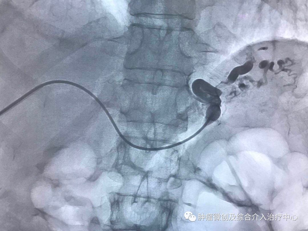 运城第一医院肿瘤介入科专家,运城市第一医院介入科专家