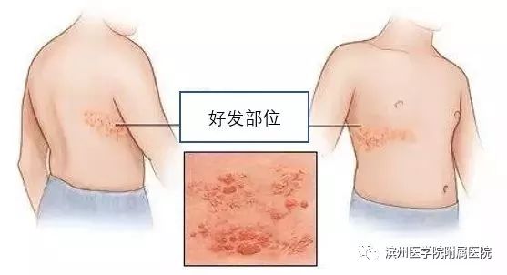 缠腰龙又疼又痒怎么办,缠腰龙疼起来很要命