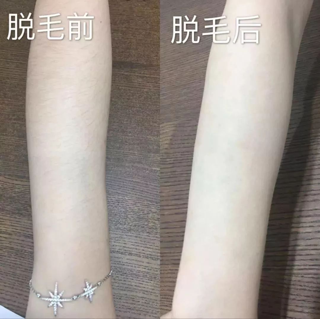 女士永久脱毛推荐排行榜第一名,美容永久脱毛抖音团购