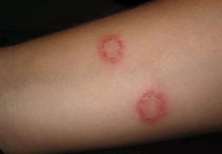 猫癣传染了给人该怎么办,人被传染上猫癣能用皮特芬吗