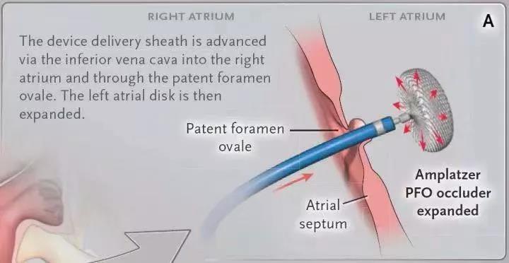卵圆孔封堵术后脑梗复发几率,卵圆孔未闭封堵能治头痛吗