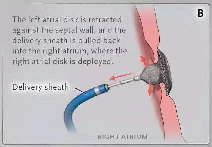 卵圆孔封堵术后脑梗复发几率,卵圆孔未闭封堵能治头痛吗