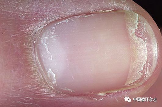 指甲代表肝功能吗,指甲病是肝不好吗