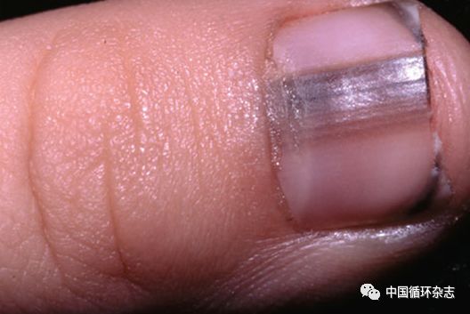 指甲代表肝功能吗,指甲病是肝不好吗