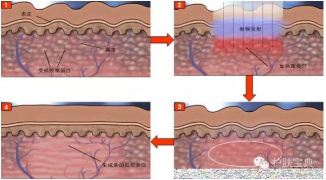 激光祛斑美容科普视频,激光美容有哪些优点和缺点