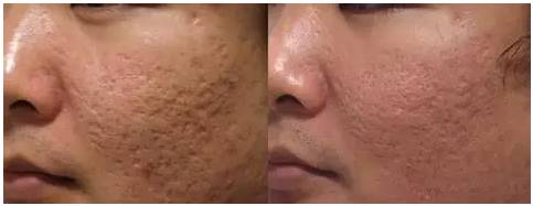 激光祛斑美容科普视频,激光美容有哪些优点和缺点