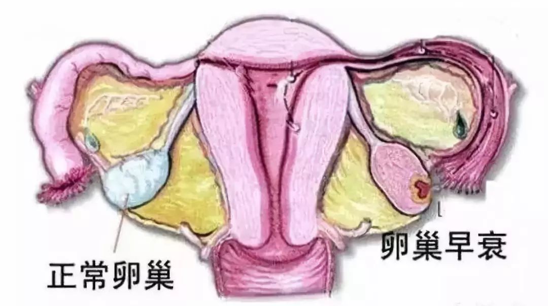 听到卵巢“早衰”，你害怕了吗？