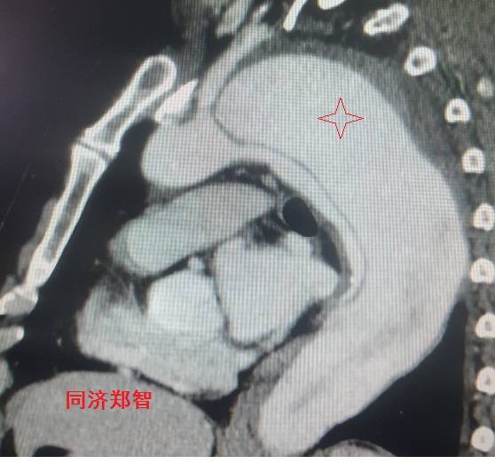 主动脉夹层cta能扫描出来吗,急性主动脉夹层cta影像诊断与鉴别