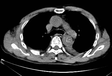 主动脉夹层cta能扫描出来吗,急性主动脉夹层cta影像诊断与鉴别