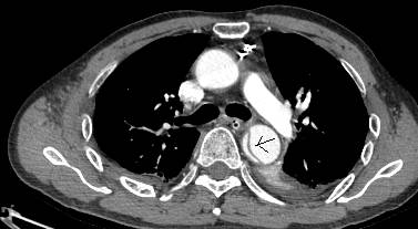 主动脉夹层cta能扫描出来吗,急性主动脉夹层cta影像诊断与鉴别
