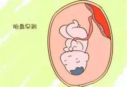 摔一跤能造成胎停吗,产妇去产房时摔倒母子双亡