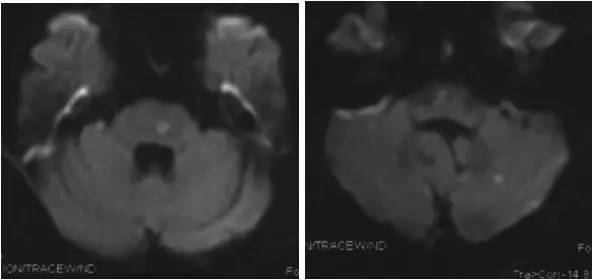 基底动脉狭窄介入治疗的病例分享,天坛医院颈动脉闭塞的介入治疗