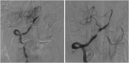 基底动脉狭窄介入治疗的病例分享,天坛医院颈动脉闭塞的介入治疗