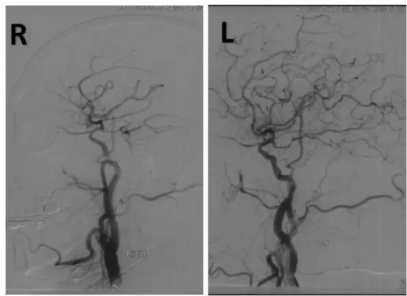 基底动脉狭窄介入治疗的病例分享,天坛医院颈动脉闭塞的介入治疗