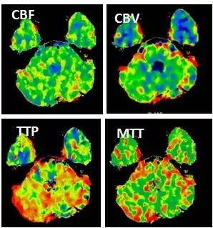 基底动脉狭窄介入治疗的病例分享,天坛医院颈动脉闭塞的介入治疗