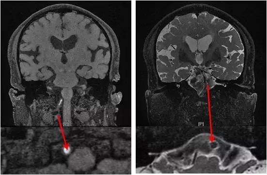 基底动脉狭窄介入治疗的病例分享,天坛医院颈动脉闭塞的介入治疗