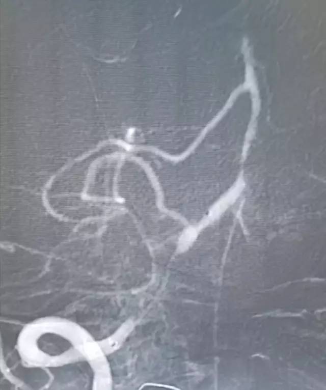 基底动脉狭窄介入治疗的病例分享,天坛医院颈动脉闭塞的介入治疗